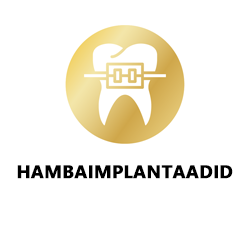 Hambaimplantaadi paigaldus All-on-4
